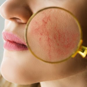 A photo of a magnifying glass on a woman's face revealing redness and dilated blood vessels