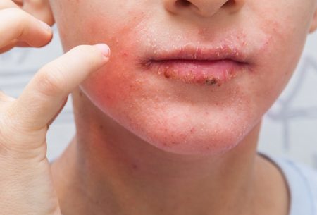 A close-up photo of a young person with a rash around their mouth